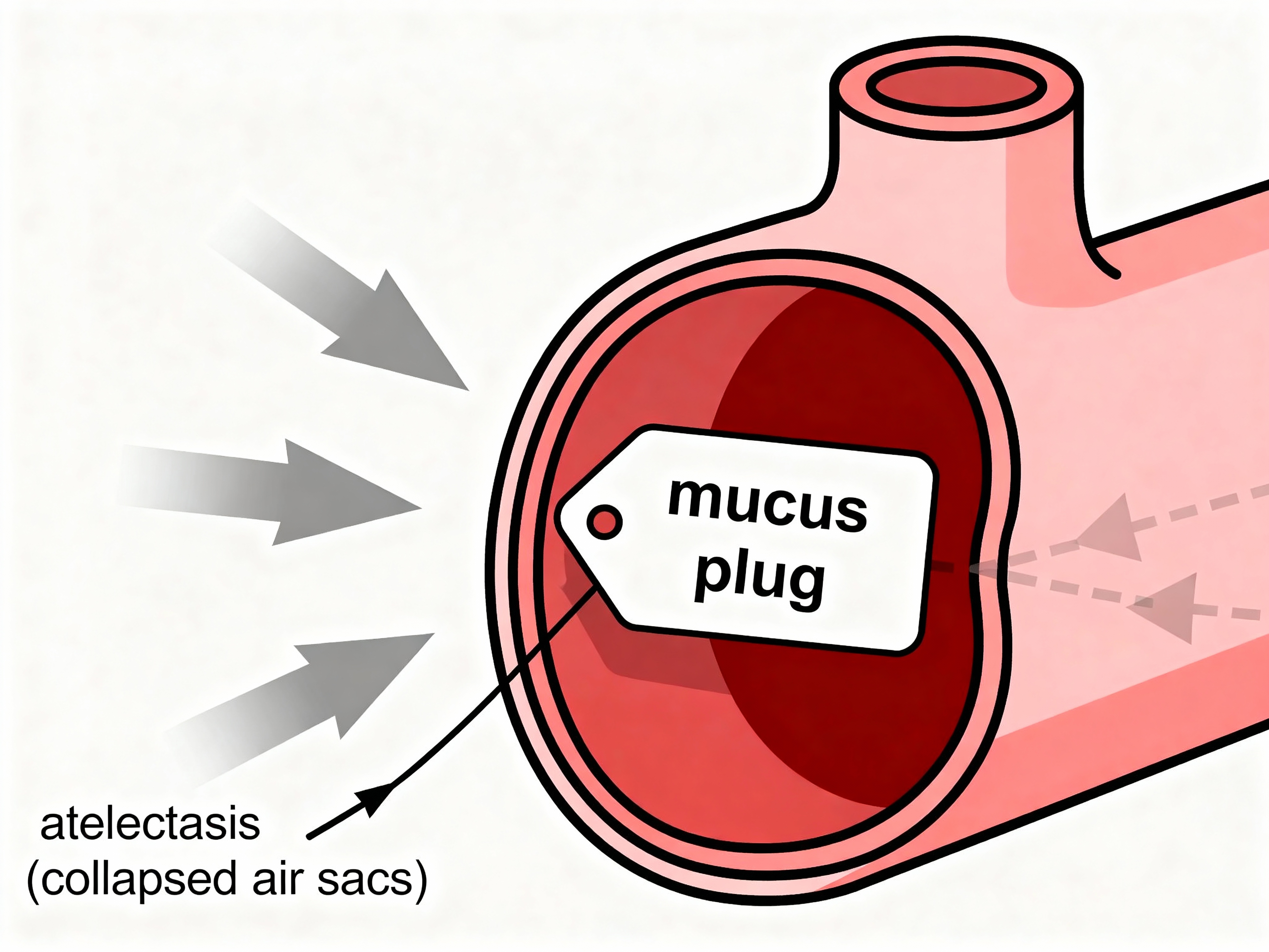 Educational diagram of a bronchus blocked by a mucus plug with airflow arrows and an atelectasis (collapsed air sacs) callout