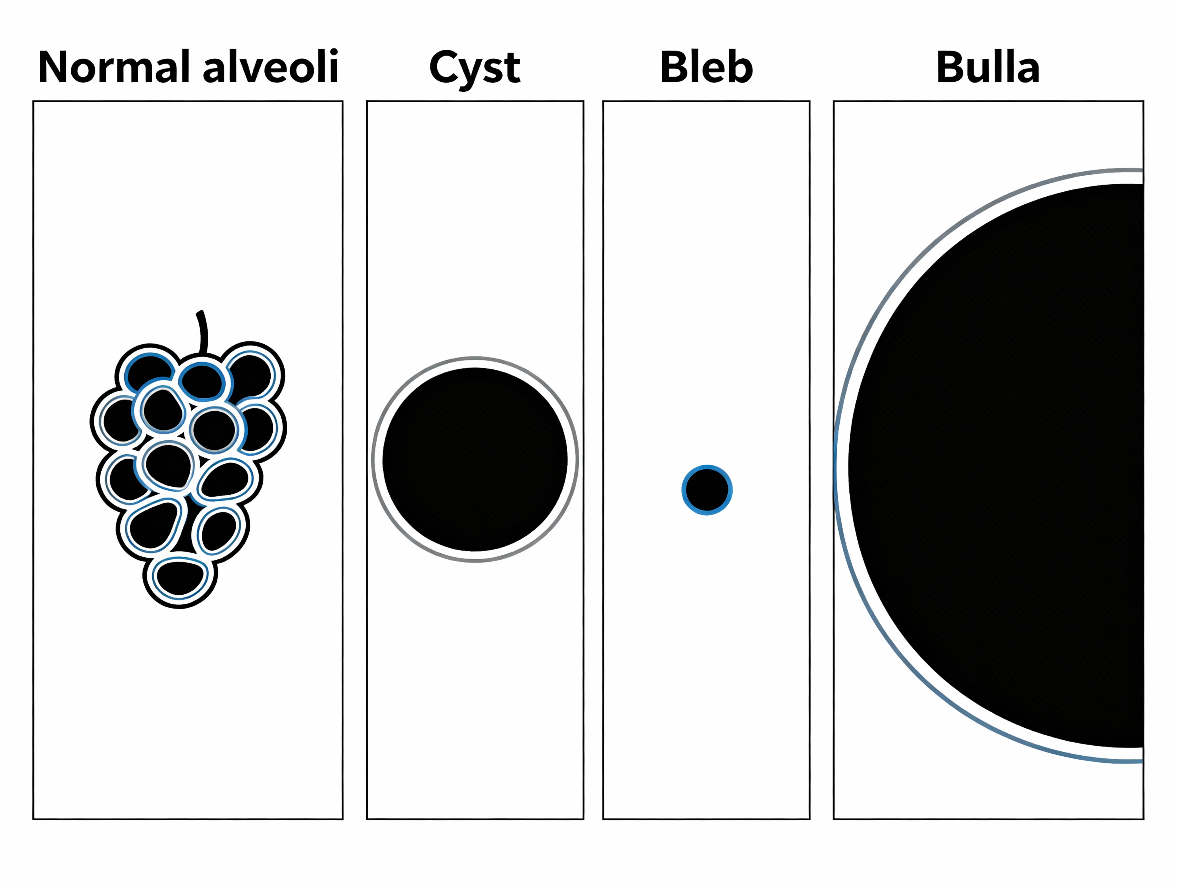 Normal alveoli vs cyst vs bleb vs bulla – medical diagram Medical diagram: normal alveoli vs lung cyst vs bleb vs bulla, side-by-side labeled comparison on a white background