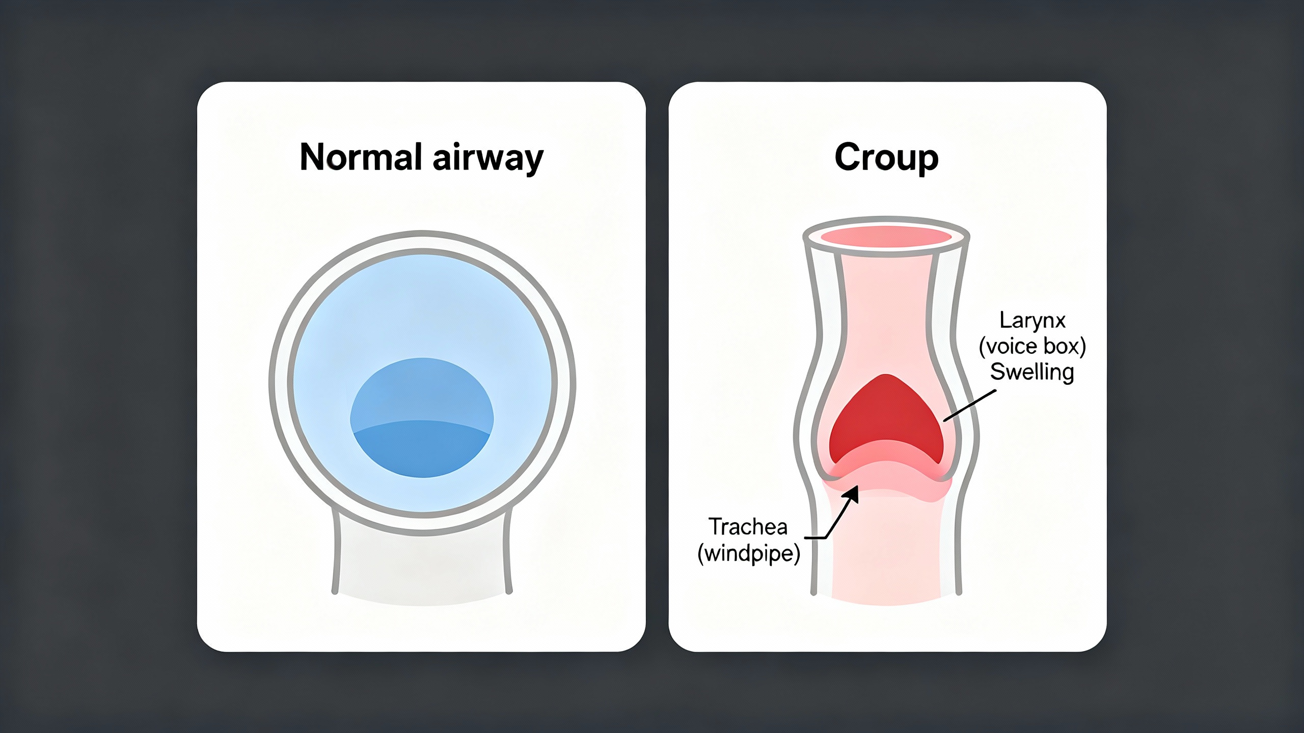 Normal airway vs croup: larynx, trachea, and subglottic swelling Normal airway vs croup diagram showing larynx (voice box), trachea (windpipe), and subglottic swelling