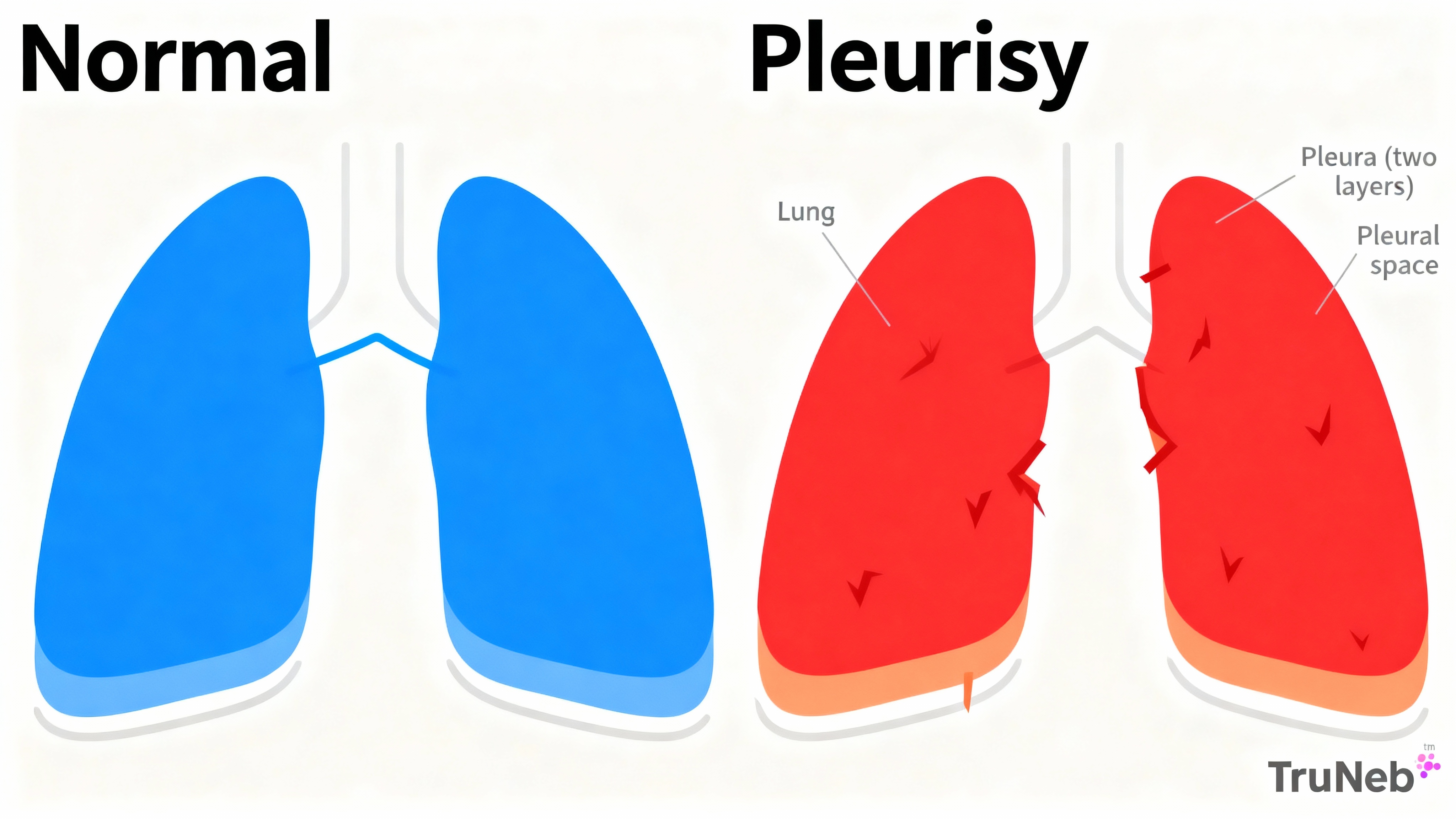 Normal pleura vs pleurisy diagram showing inflamed pleural layers and pleural space